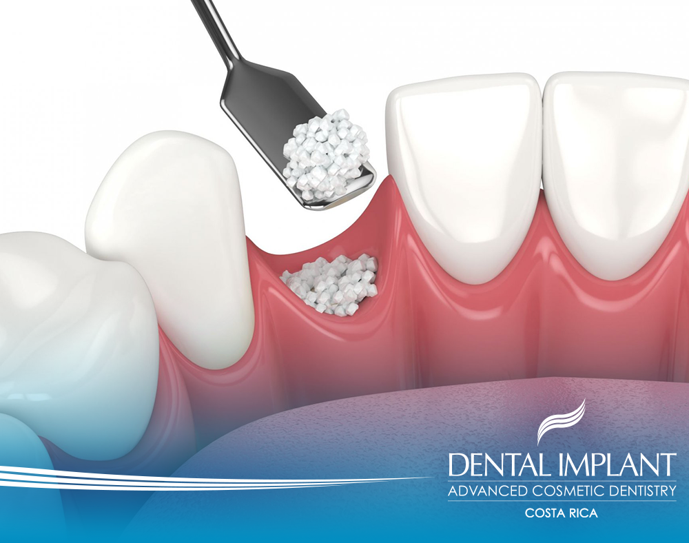 BoneGrafting