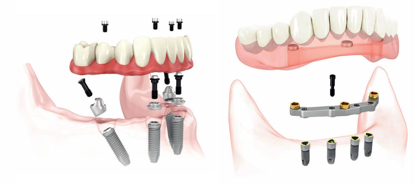 all-on-four-procedure-dental-implant-costa-rica all-on-four-procedure-dental-implant-costa-rica
