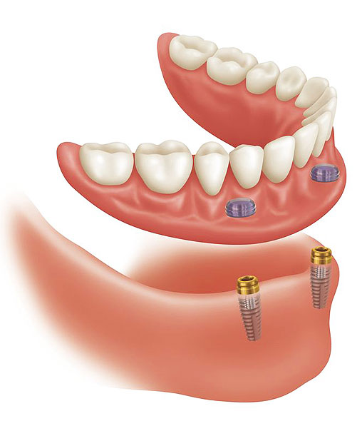 overdenture-costa-rica