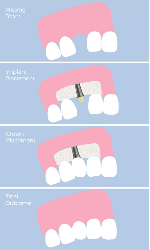 single-tooth-replacement-costa-rica