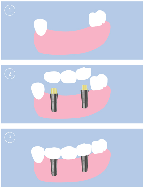 supported-bridge supported-bridge